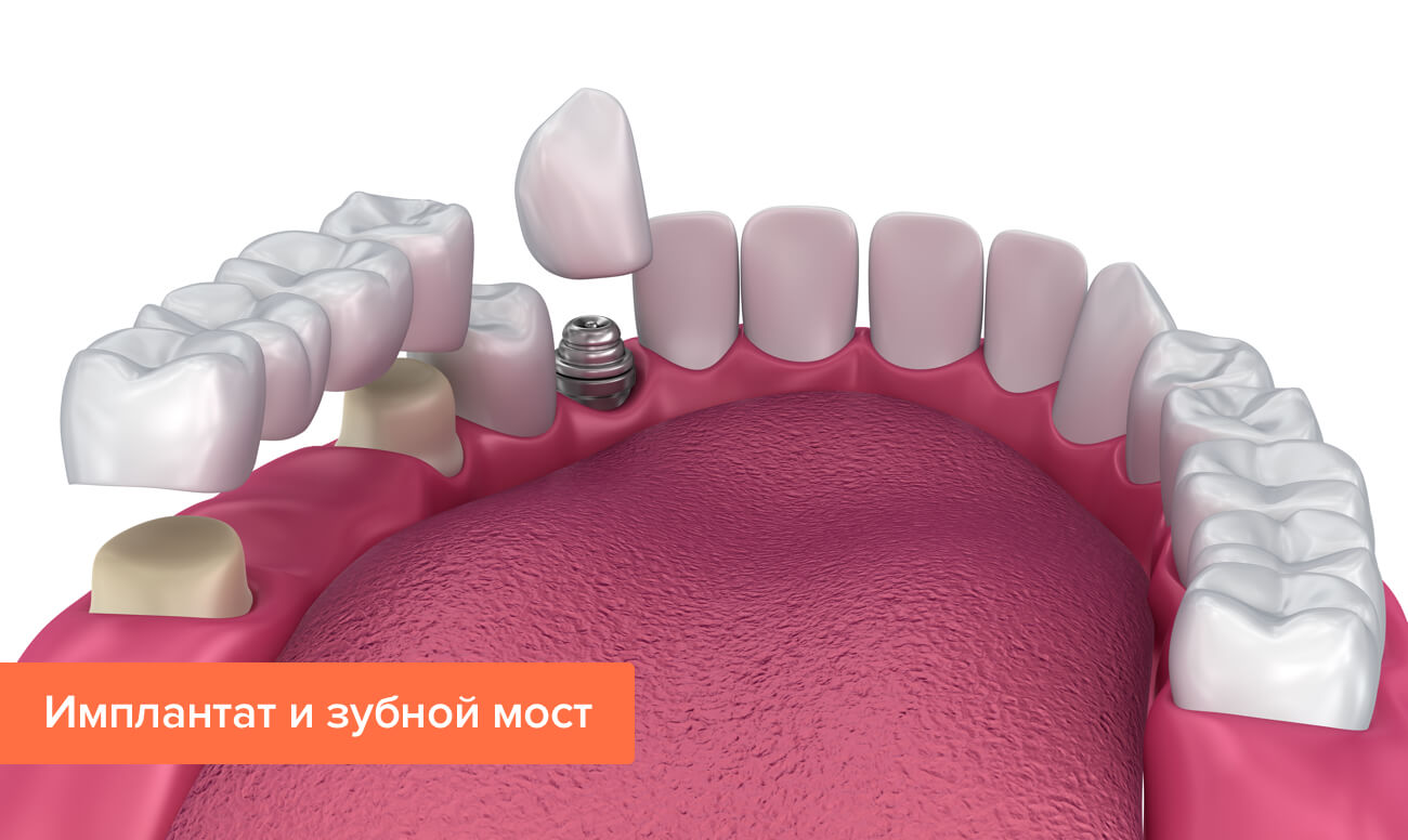 Имплантат и зубной мост в картинках