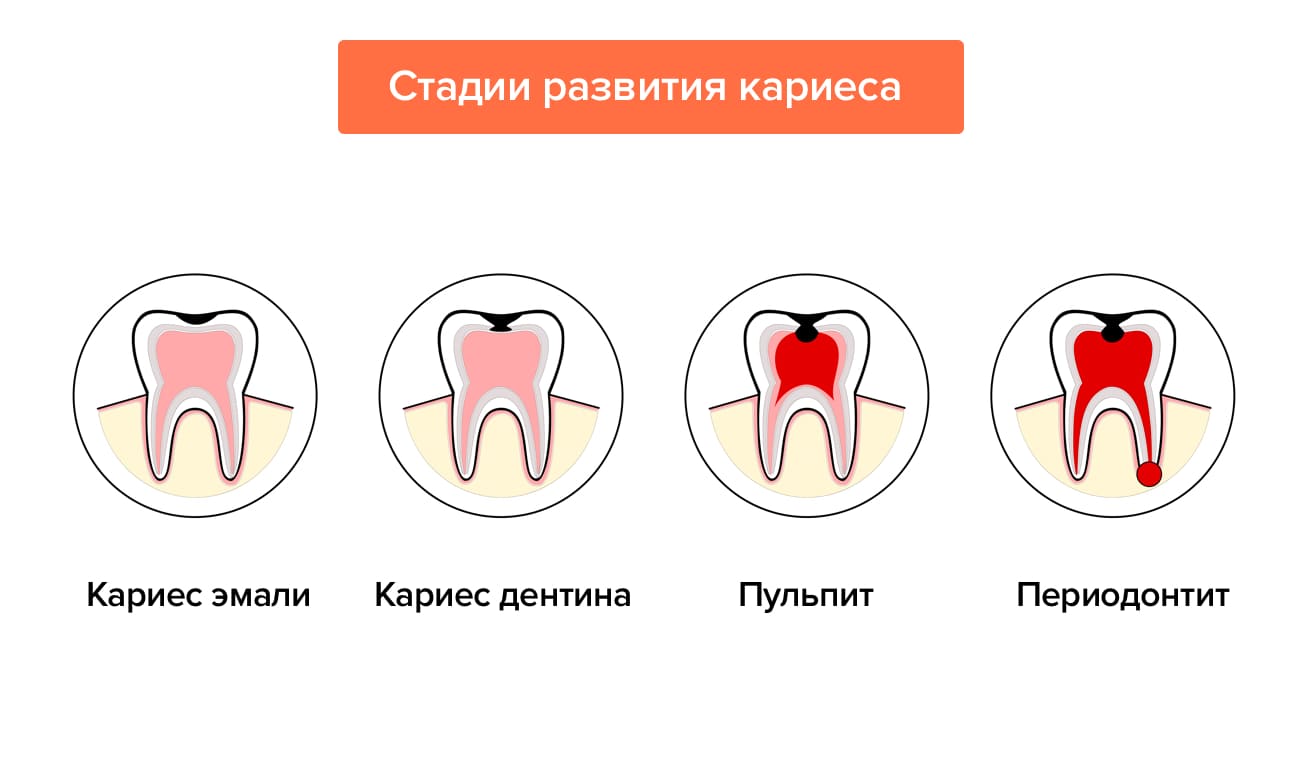 Стадии развития кариеса в картинках