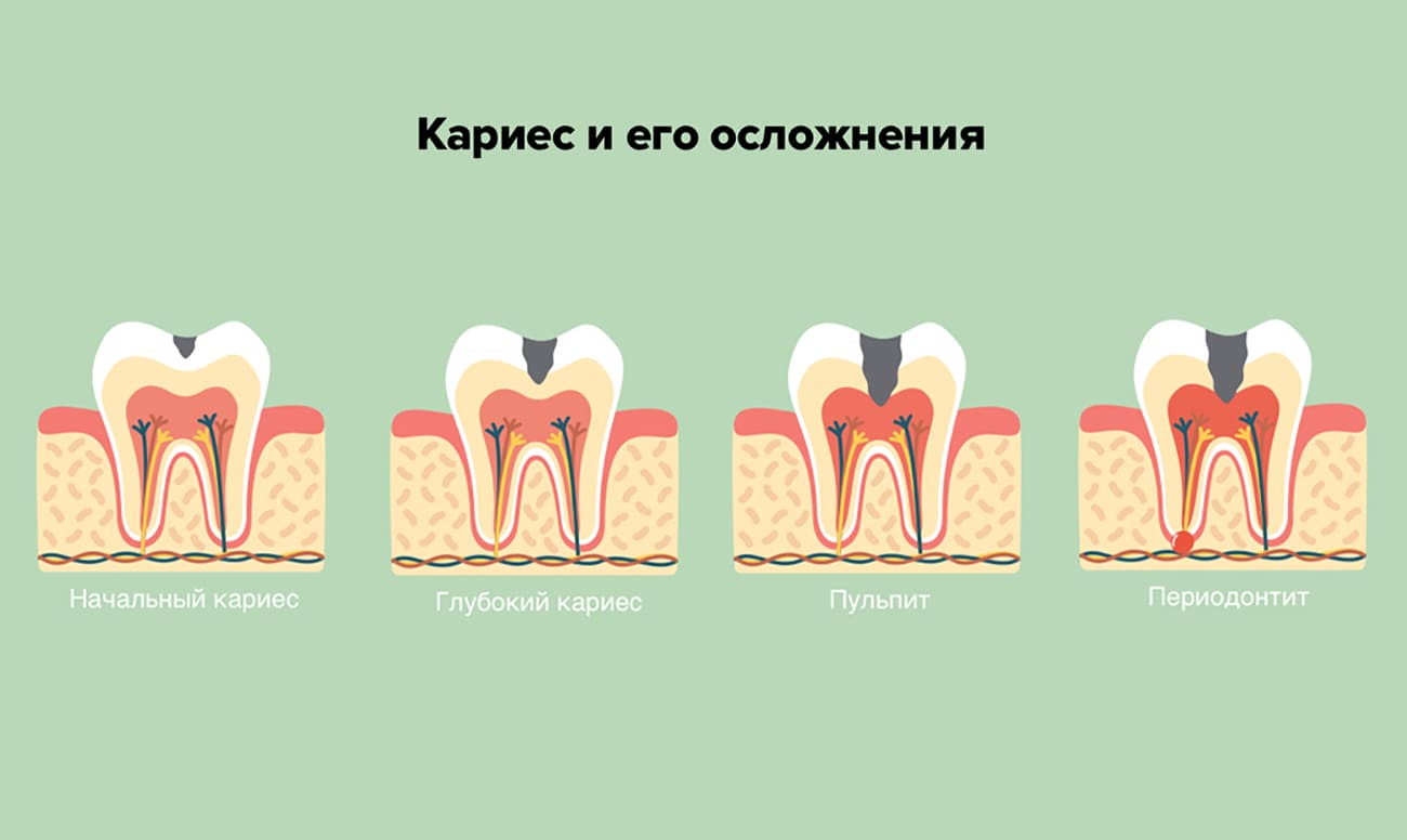 Кариес и его осложнения в картинках