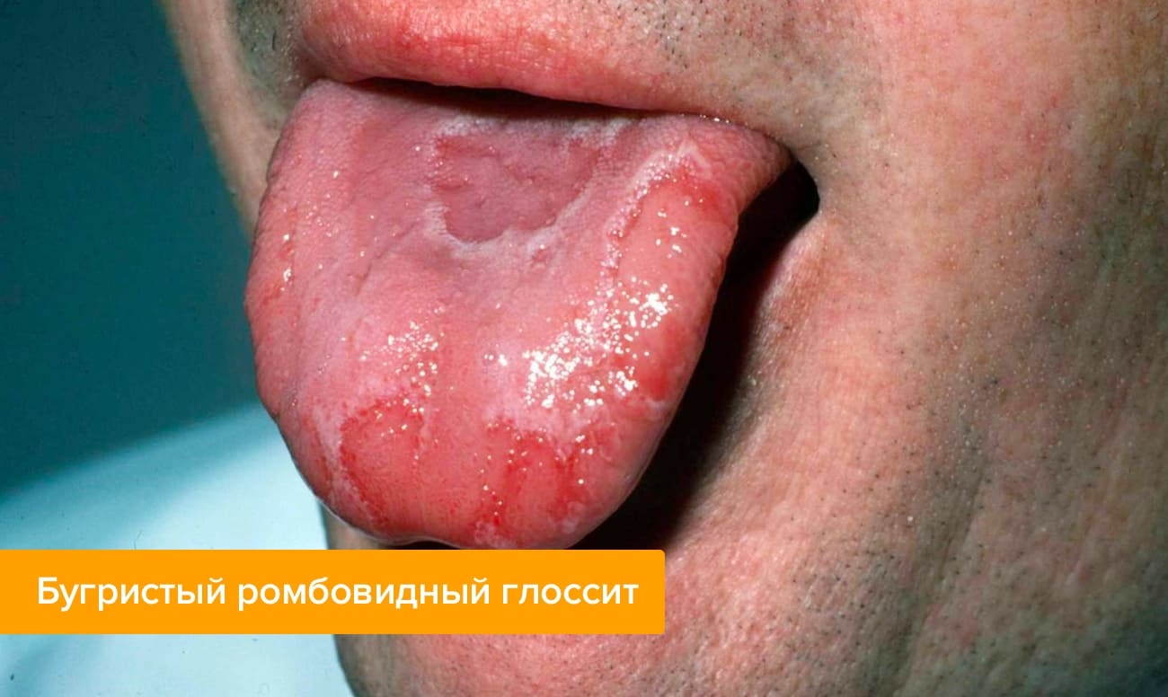 Бугристый ромбовидный глоссит Фото бугристого ромбовидного глоссита