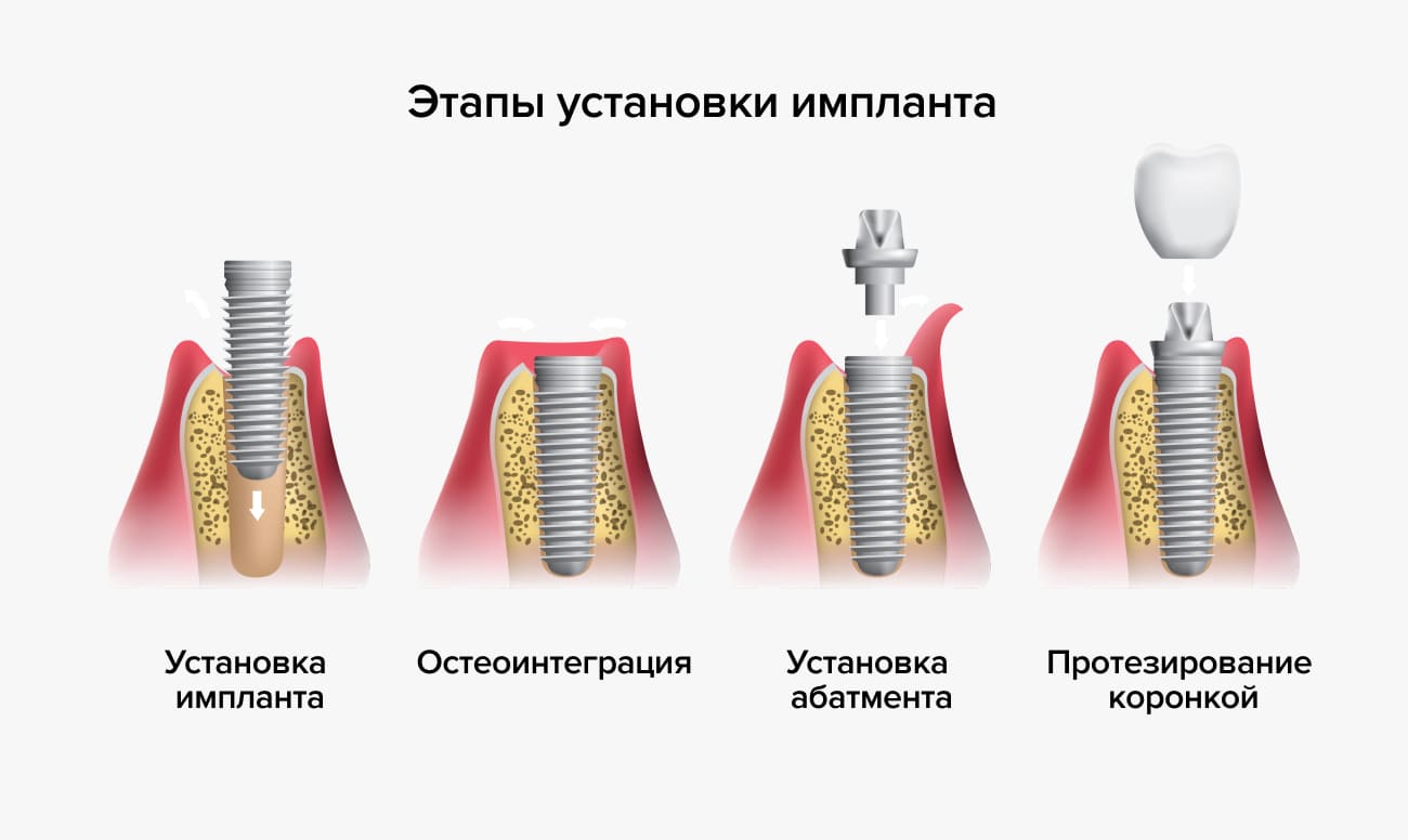 Этапы установки импланта зуба в картинках