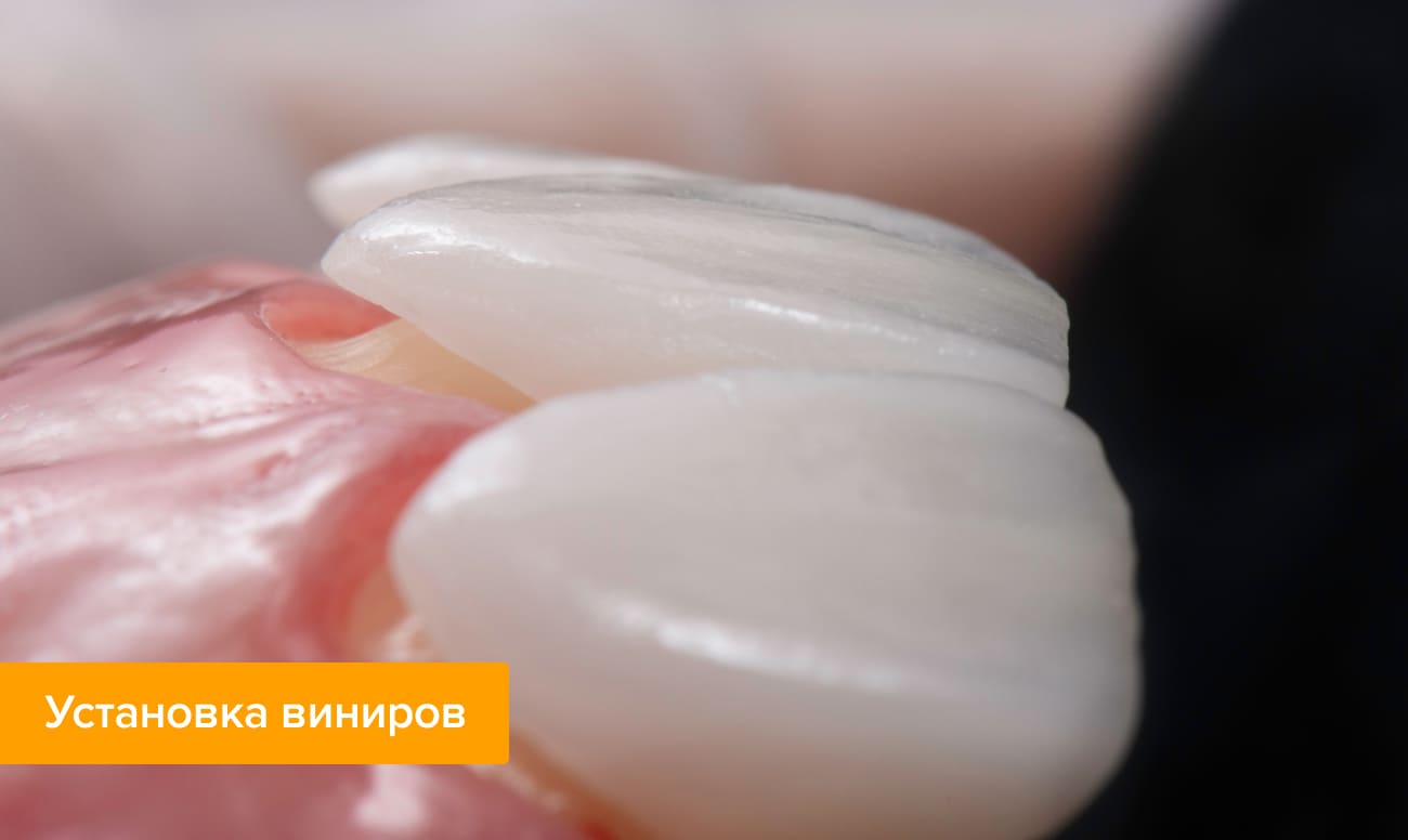 Установка виниров Фото зубов на которые устанавливаются виниры