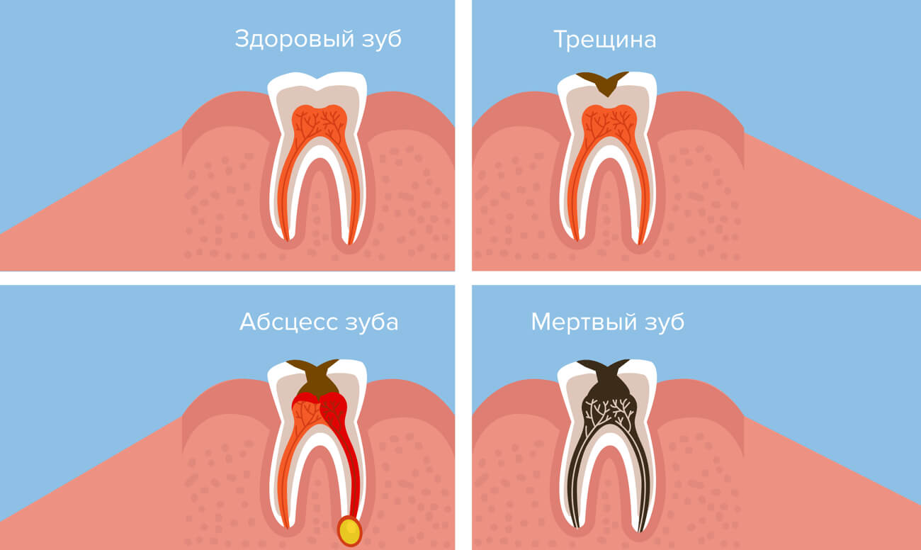 Возникновение периостита и его последствия в картинках