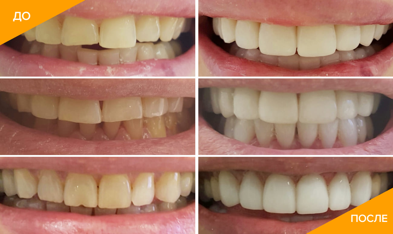 Фото зубов пациентов до и после установки люминиров в клинике Beauty Line