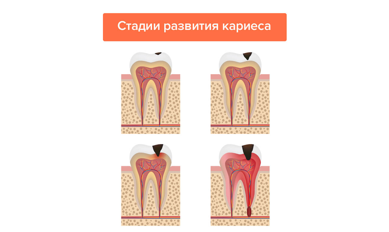 Стадии развития кариеса в картинках