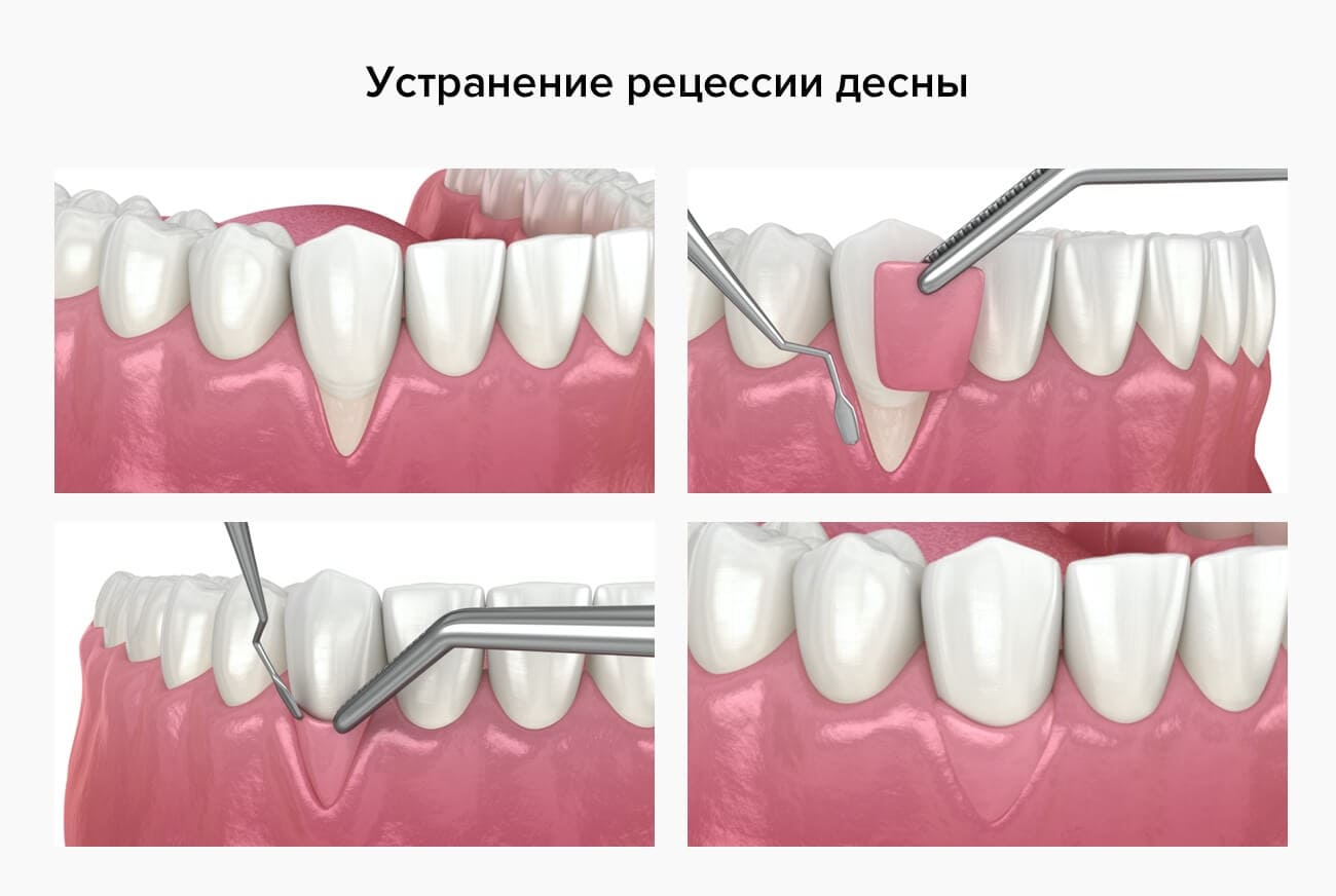 Лечение рецессии десны в картинках