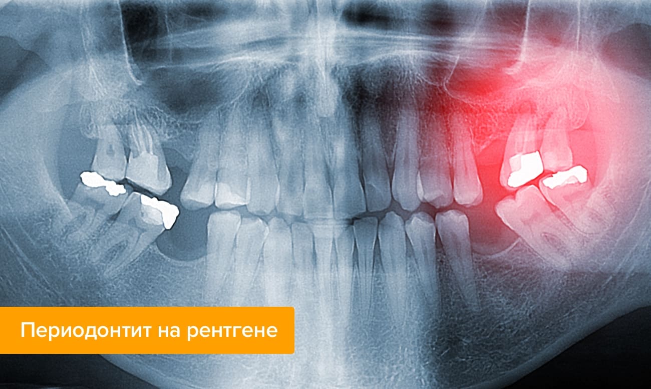 Периодонтит на рентгене