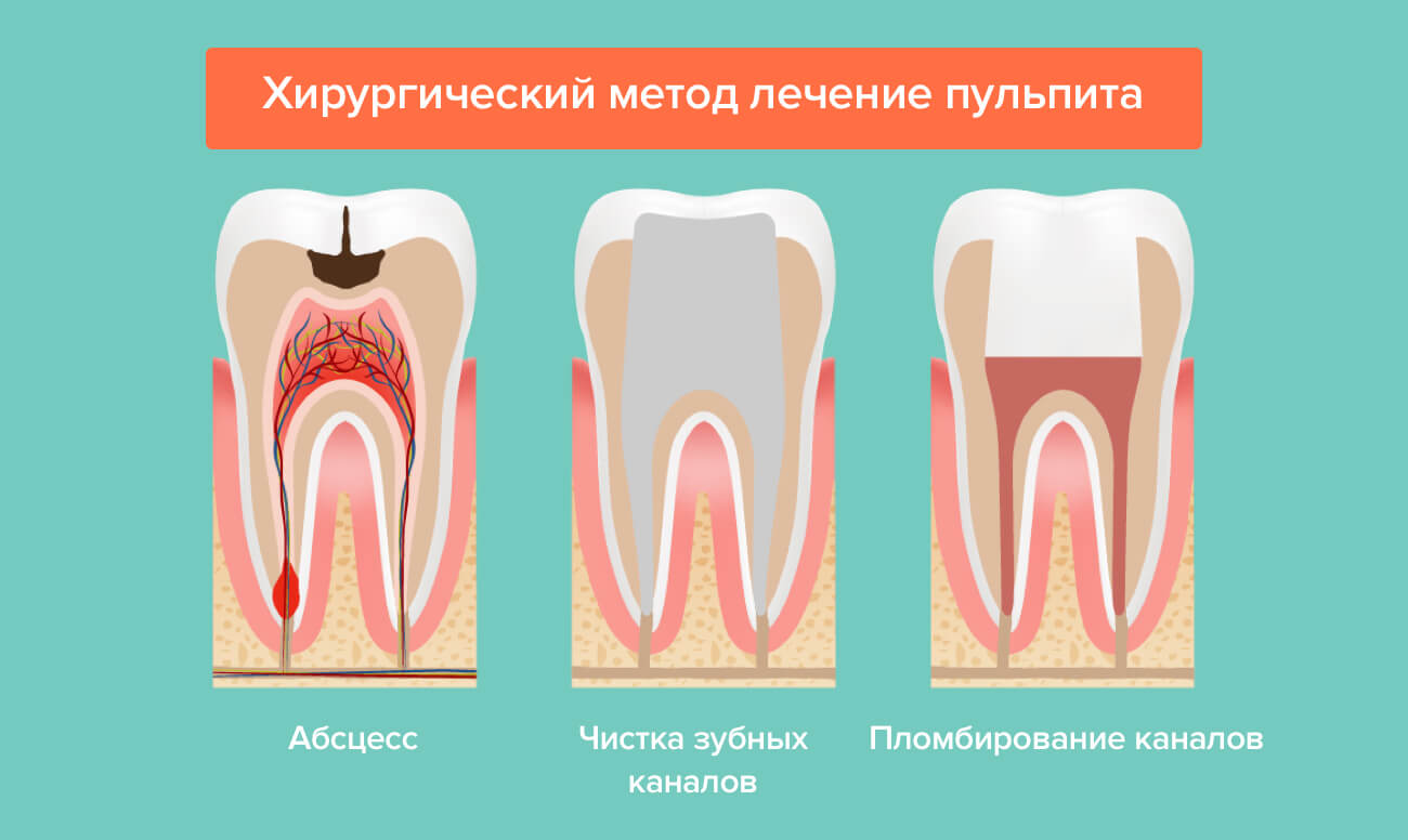 Хирургический метод лечения пульпита в картинках