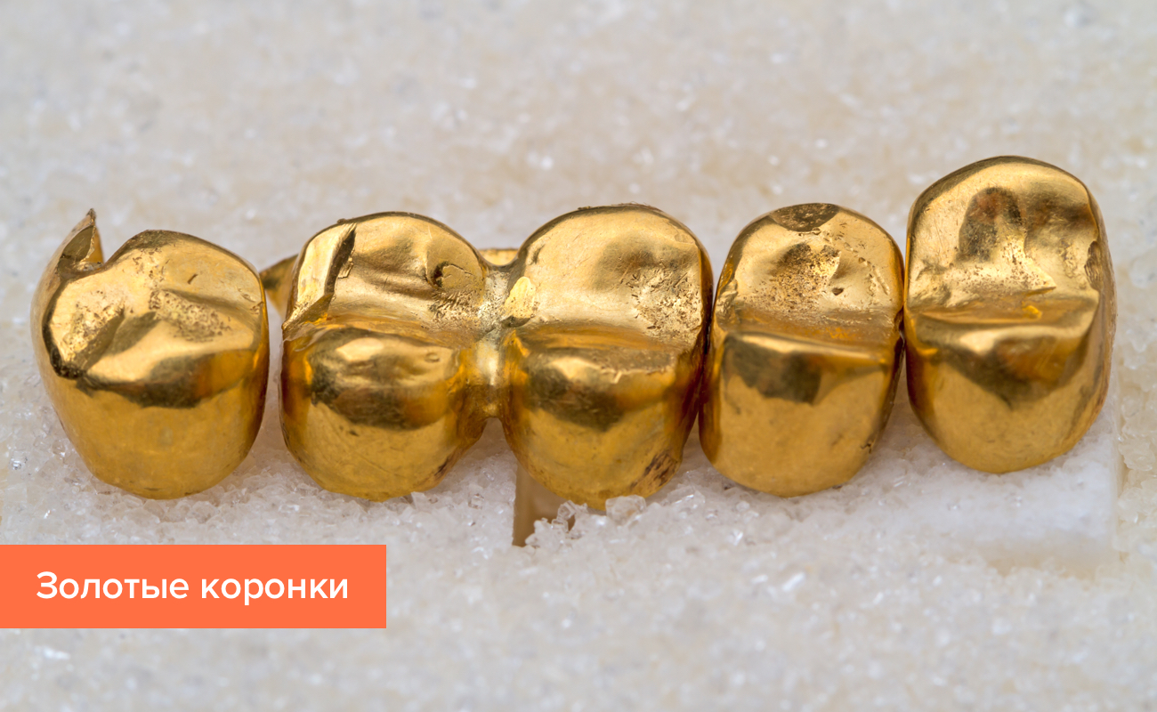 Коронка на зуб из золота Фото коронки на зуб из золота