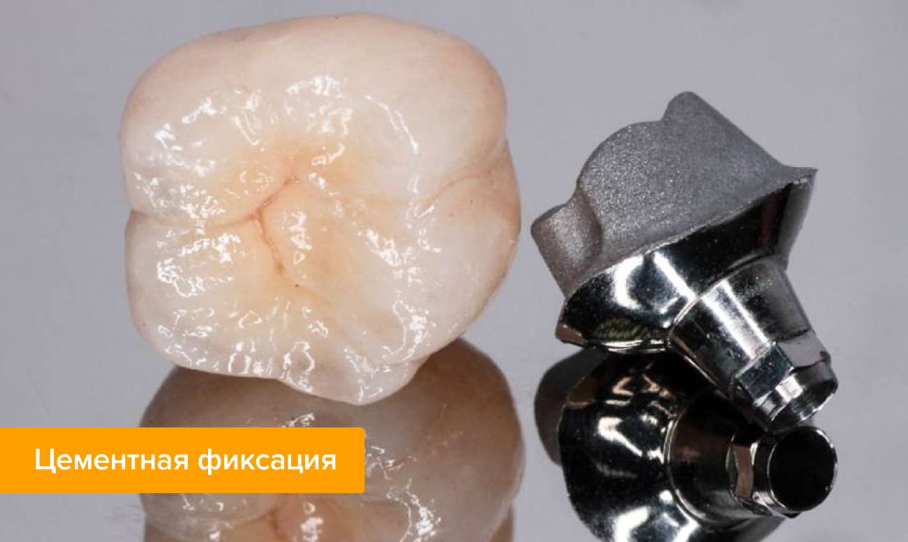 Цементная фиксация Фото коронки с абатментом для цементной фиксации