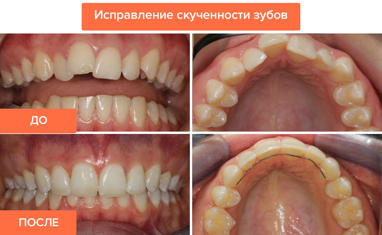 Фото этапов исправления скученности зубов
