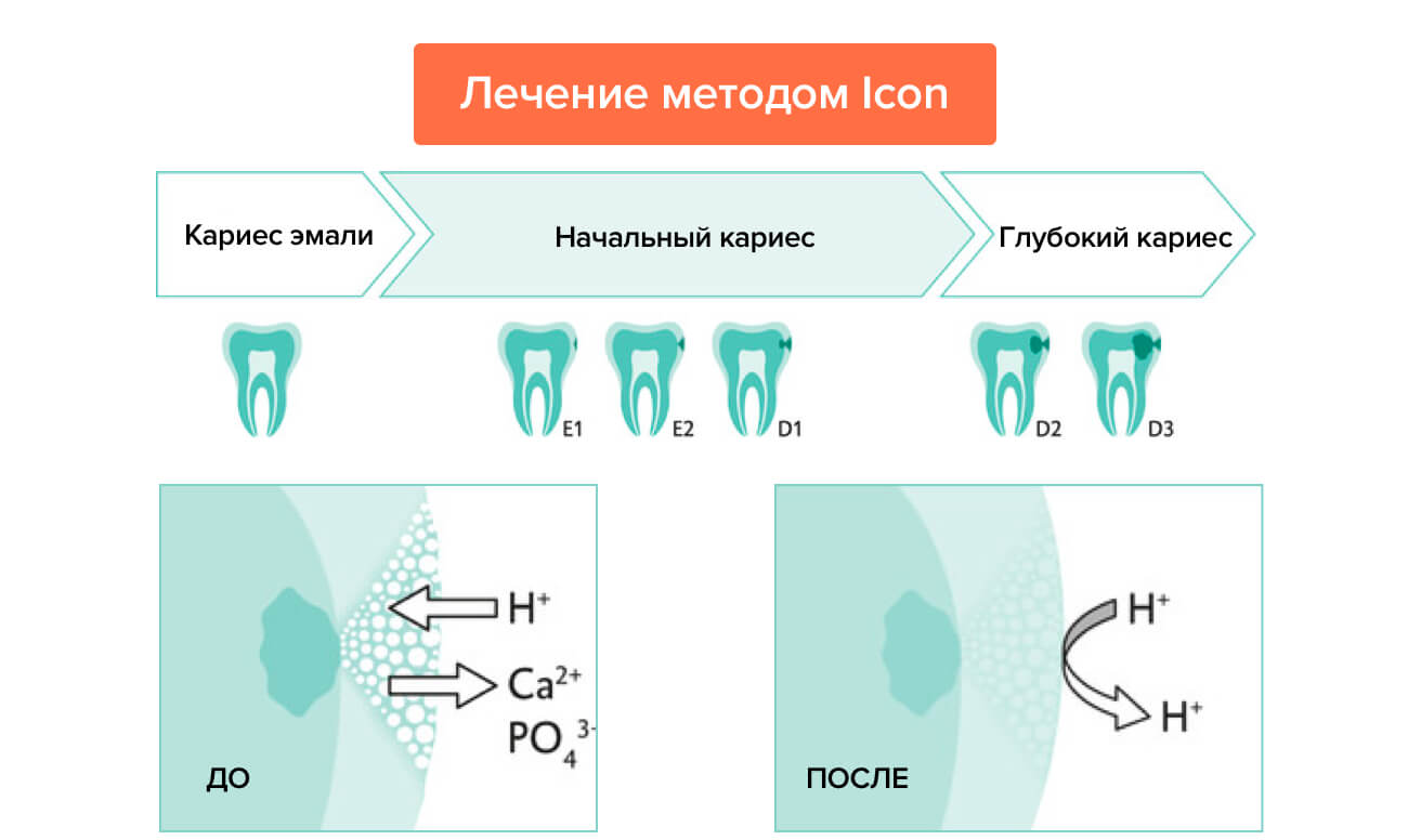 Лечение методом Icon в картинках