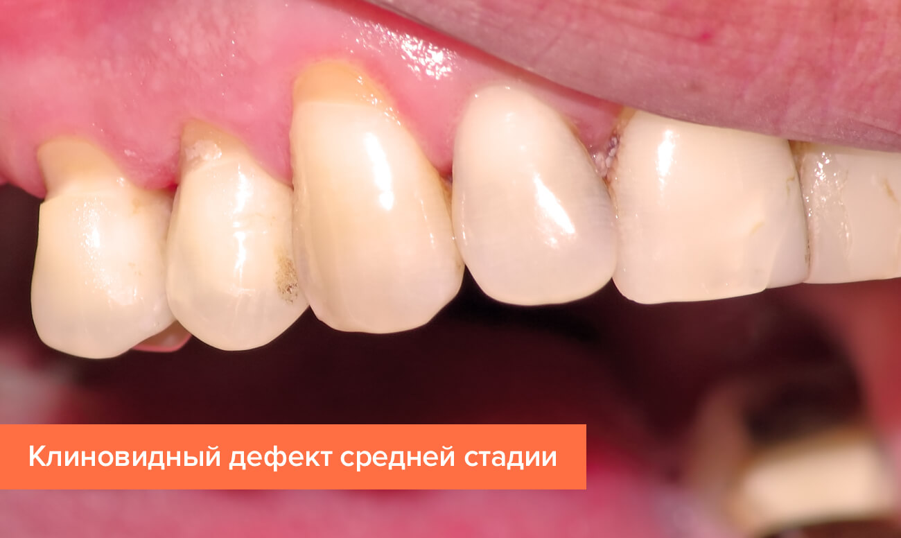 Клиновидный дефект средней стадии Фото клиновидного дефекта средней стадии