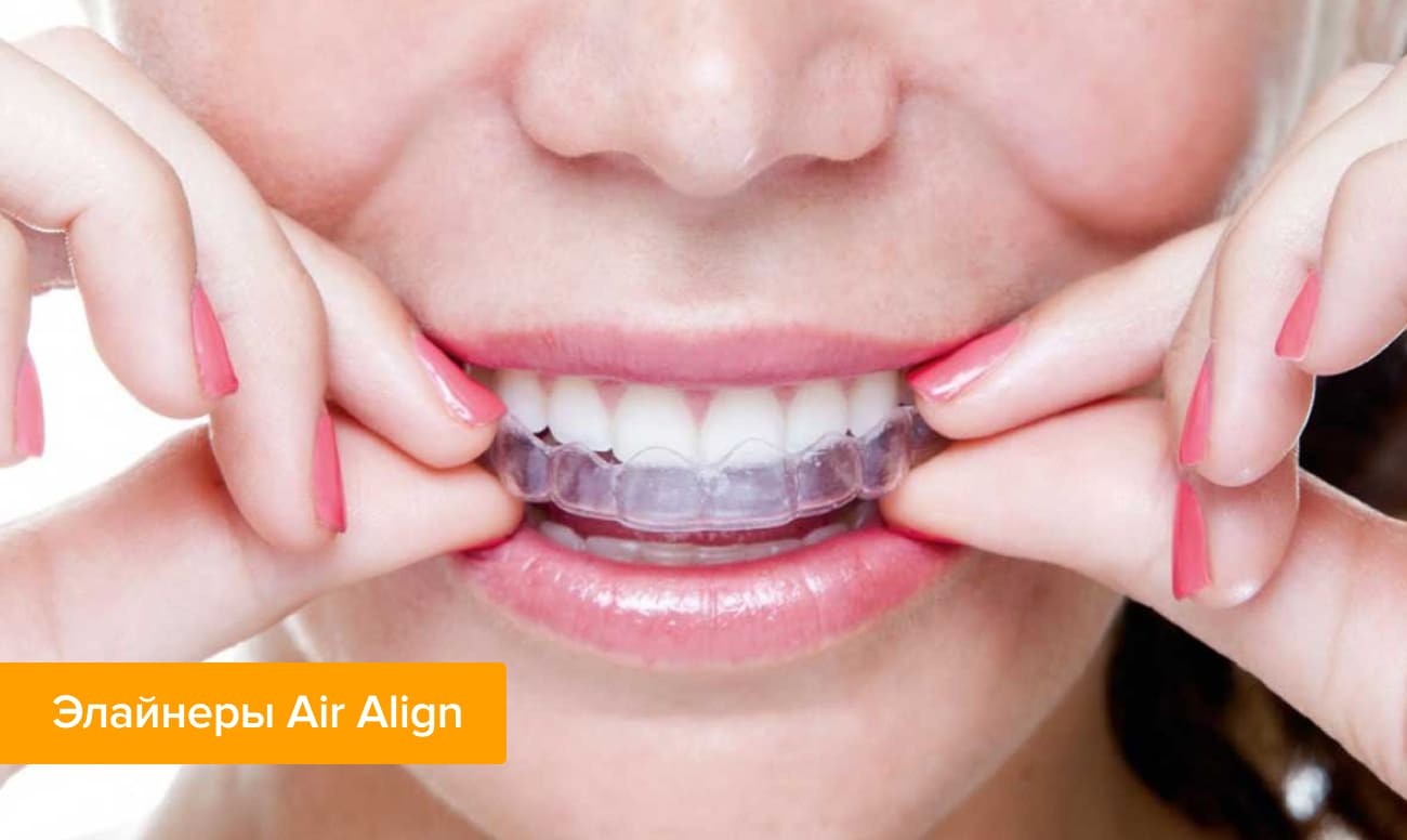 Фото элайнеров Air Align на зубах