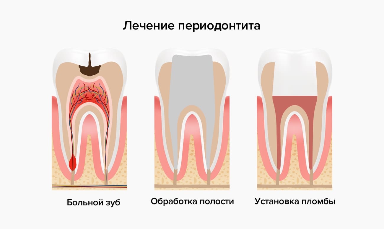 Лечения периодонтита в картинках