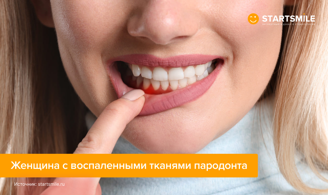 Женщина с воспаленными тканями пародонта Фото женщины с воспаленными тканями пародонта.