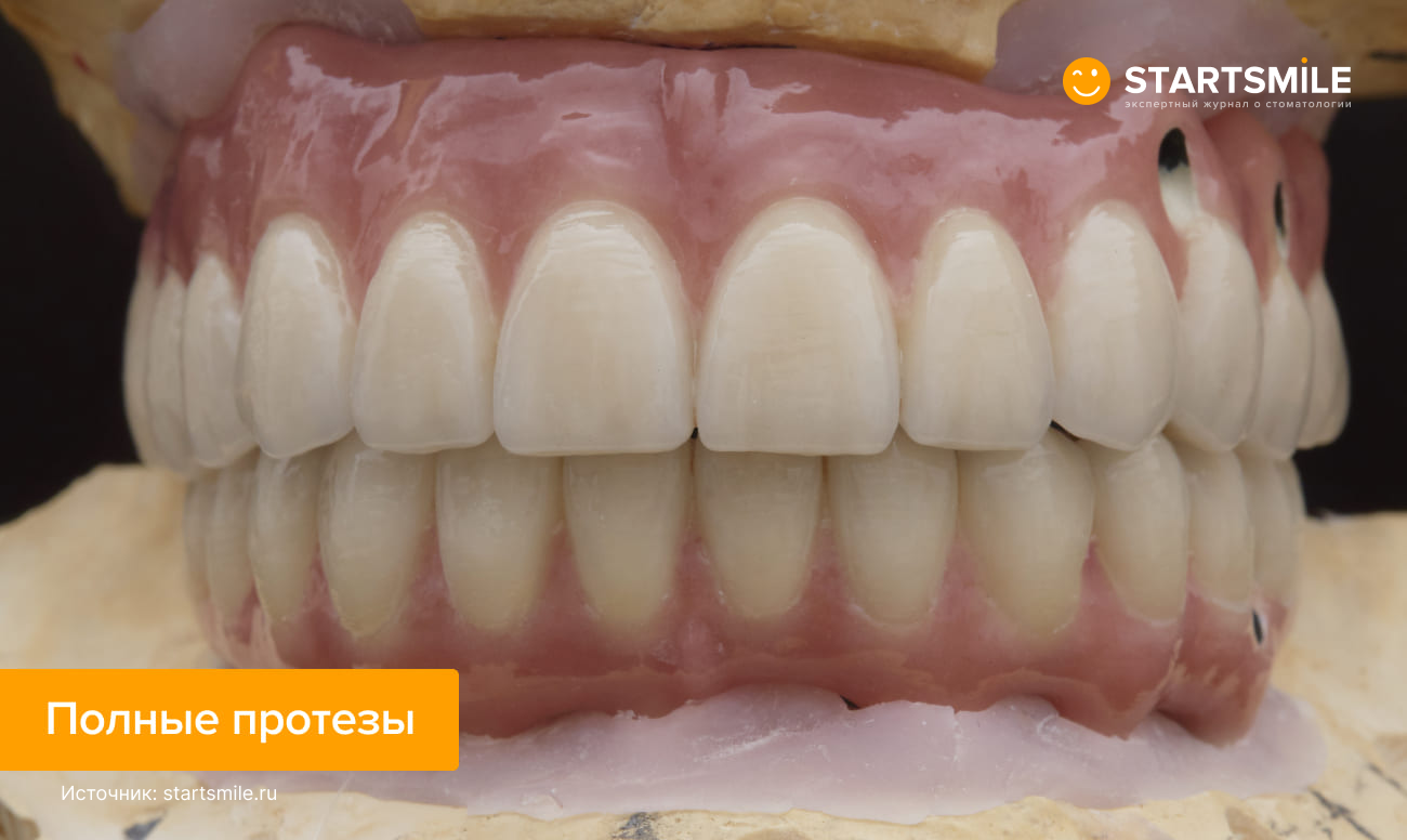 Фото полных зубных протезов на имплантах