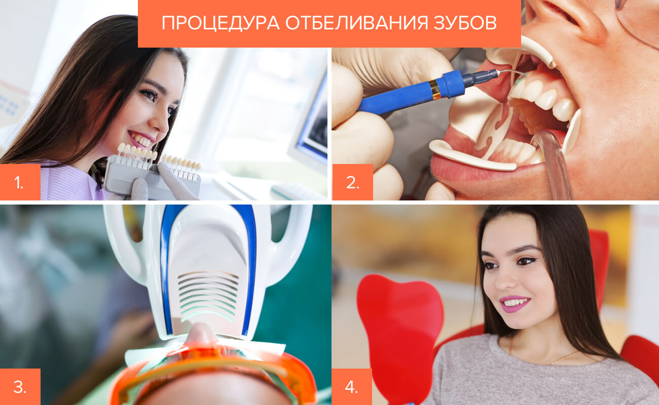 Отбеливание зубов – виды, способы, отзывы, фото