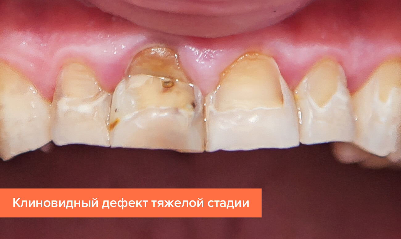 Клиновидный дефект тяжелой стадии Фото клиновидного дефекта тяжелой стадии