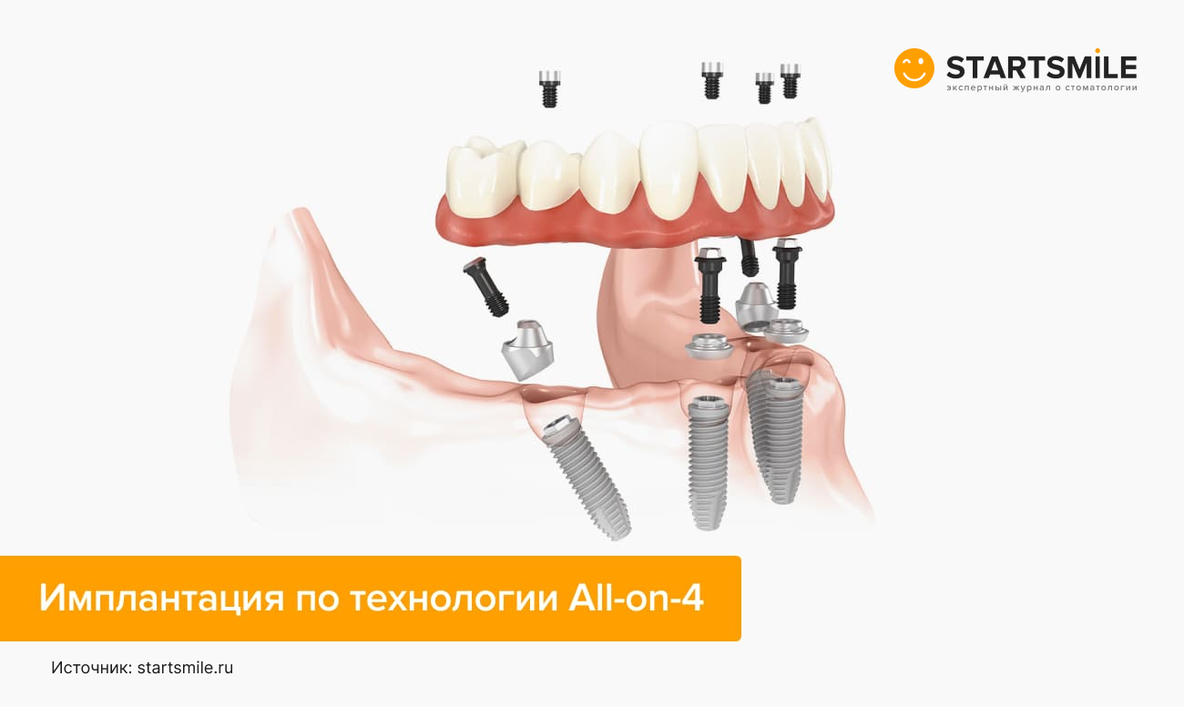 Имплантация по технологии All-on-4 в картинках