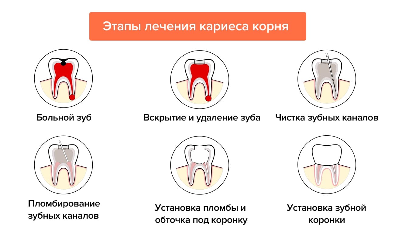 Этапы лечение кариеса корня в картинках