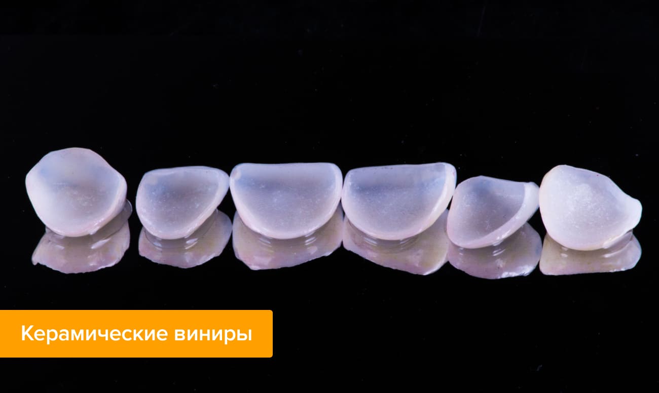 Керамические виниры Фото керамических виниров