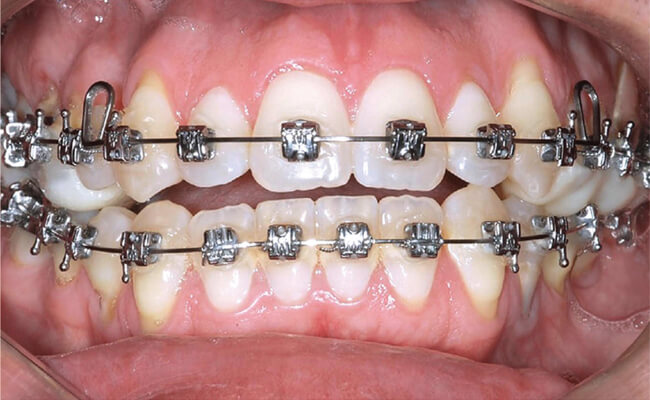 Брекеты Dentsply Generus на зубах Фото брекетов Dentsply Generus на зубах
