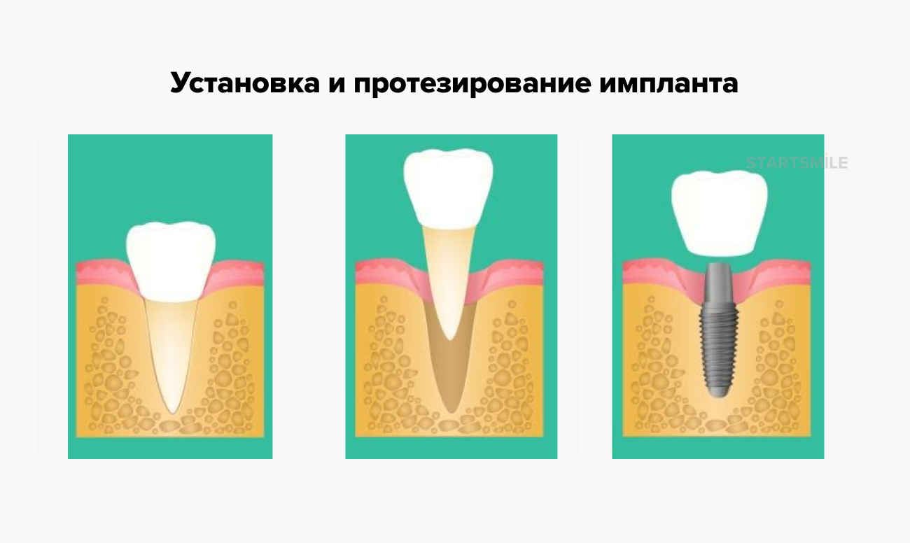 Установка и протезирование импланта Установка и протезирование импланта в картинках