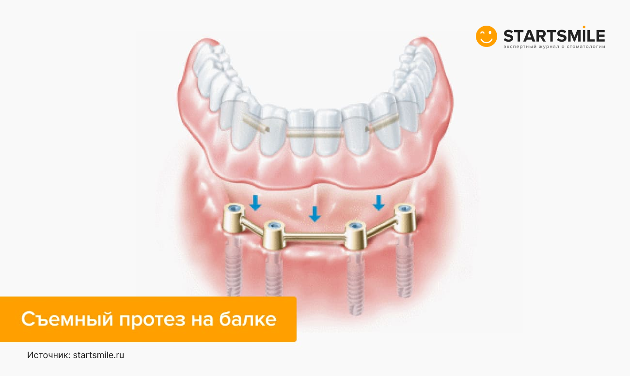 Балочное крепление съемного протеза на имплантах Балочное крепление съемного протеза на имплантах в картинках