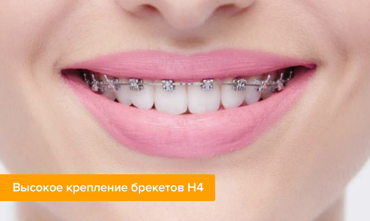 Фото самолигирующих брекетов H4 на зубах 