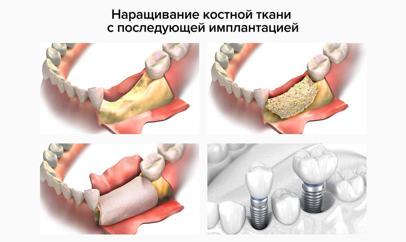 наращивание костной ткани с последующей имплантацией в картинках