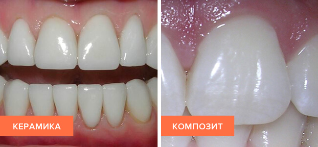 Фото виниров из керамики и композита на зубах