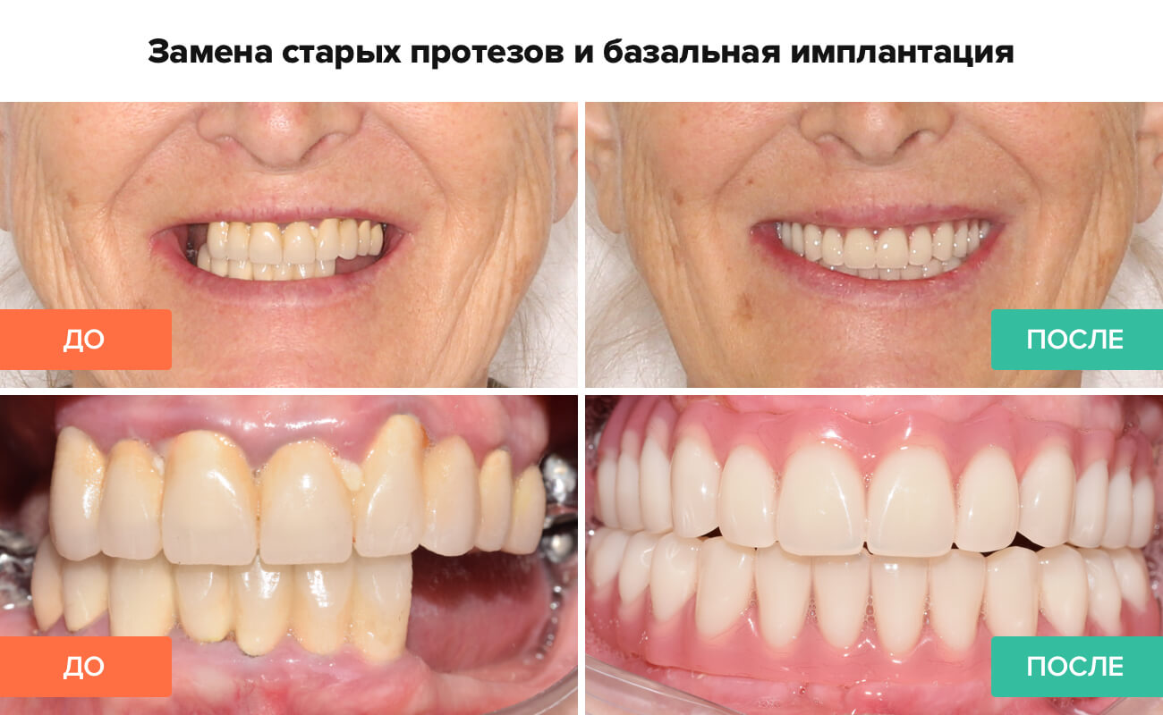 Фото до и после базальной имплантации на нижней и верхней челюсти Фото пациента до и после базальной имплантации на нижней и верхней челюсти