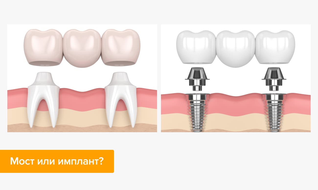 Мост или имплант в картинках