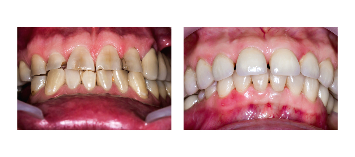 Фото пациента до и после реставрационного отбеливания