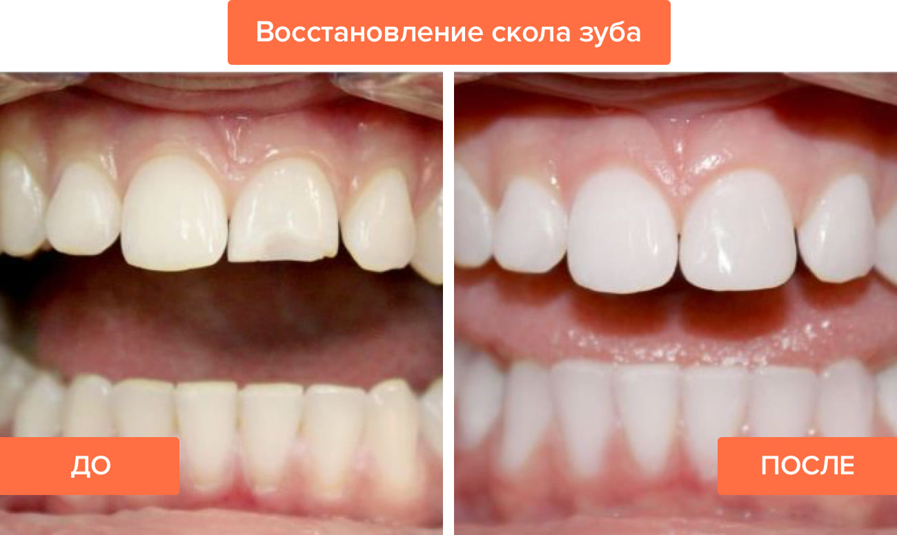 Фото до и после восстановления скола переднего зуба