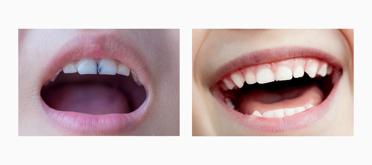 Фото пациента до и после лечения кариеса молочных зубов