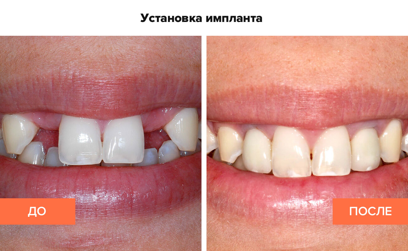 Фото пациента до и после установки импланта