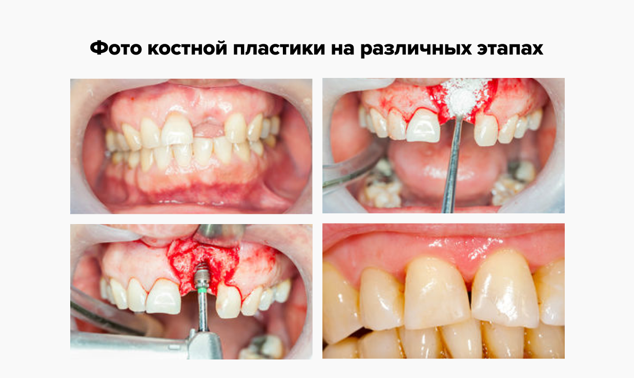 Костная пластика на различных этапах ее проведения Костная пластика на различных этапах ее проведения в фотографиях