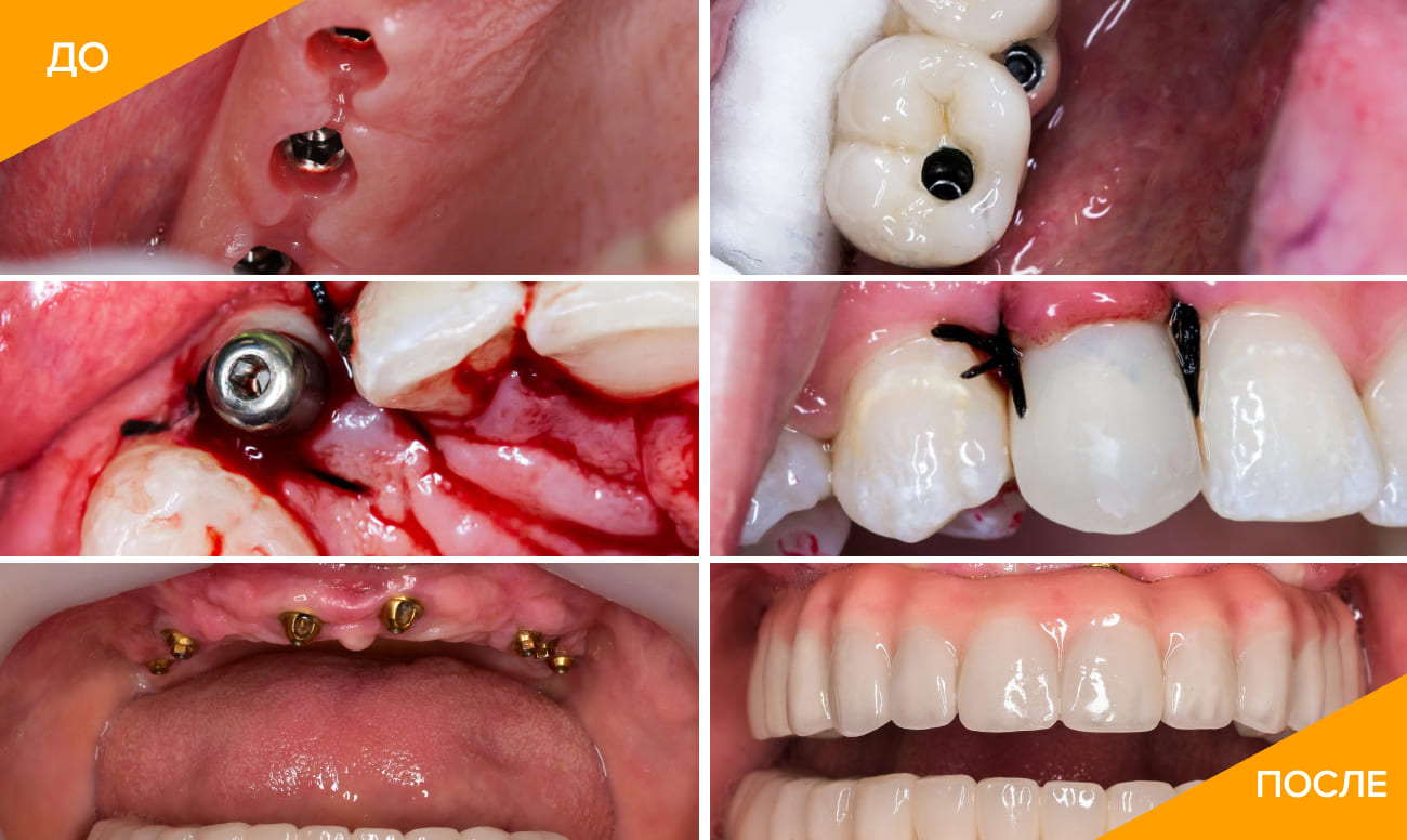 Фото до и после имплантации зубов в боковом отделе жевательных зубов, в области передних зубов и при полной адентии