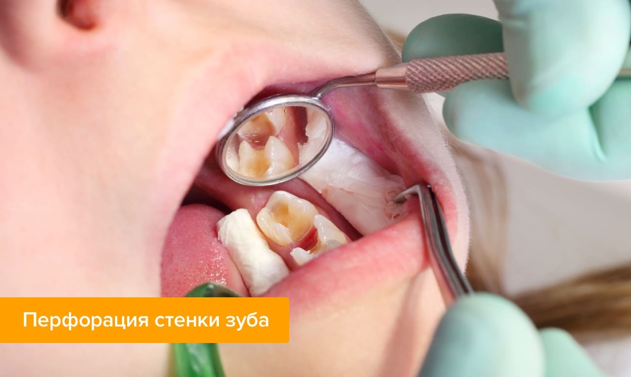 Лечение перфораций молочных зубов thumbnail