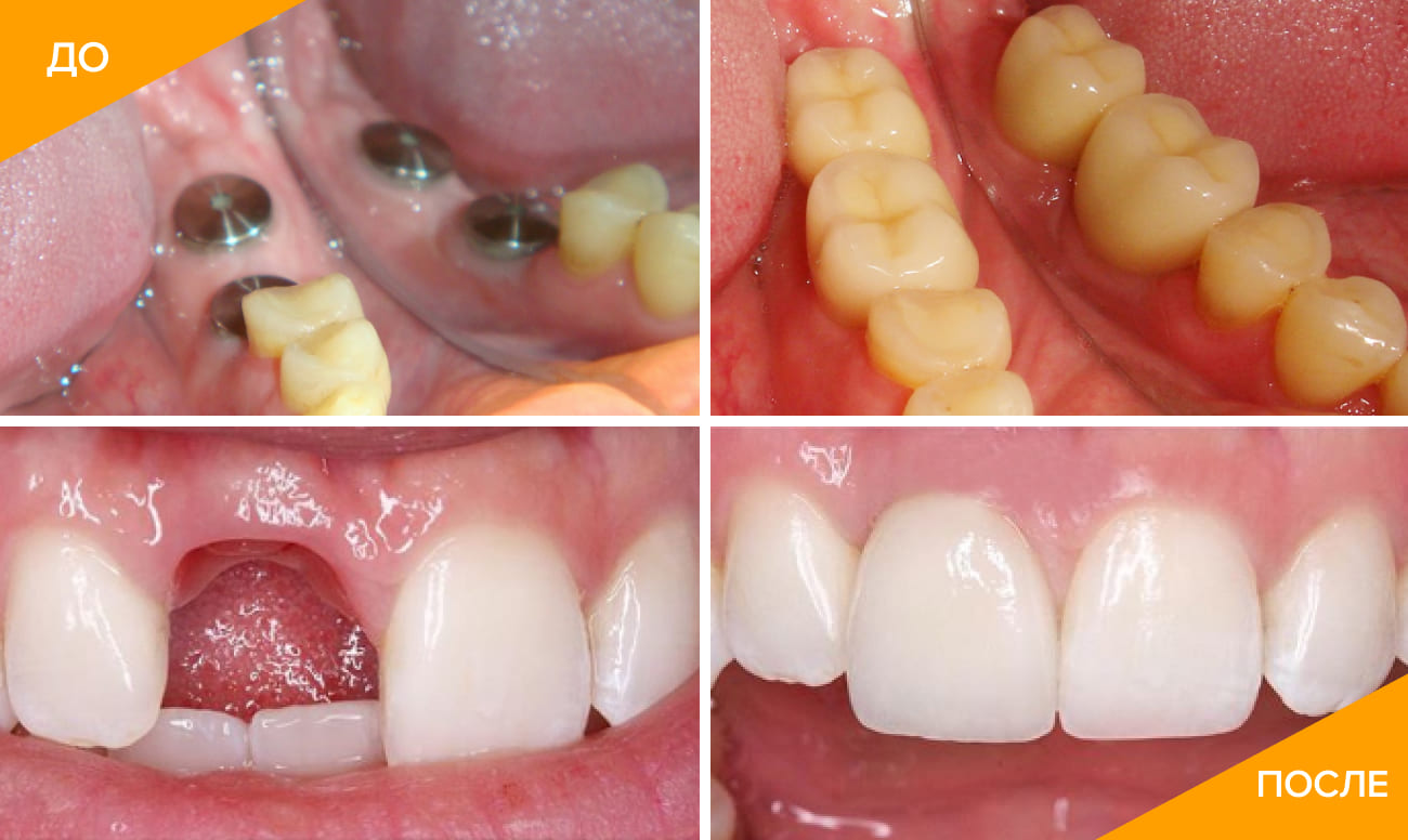 Фото до и после установки зубных имплантатов