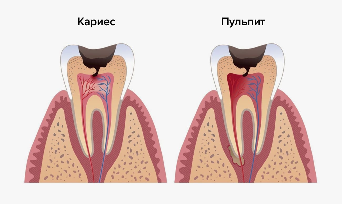 Кариес и пульпит у детей в картинках