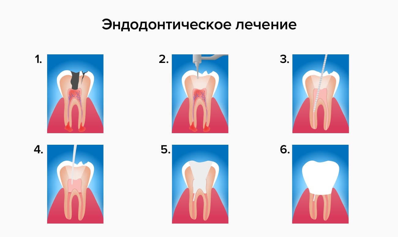 Эндодонтическое лечение в картинках