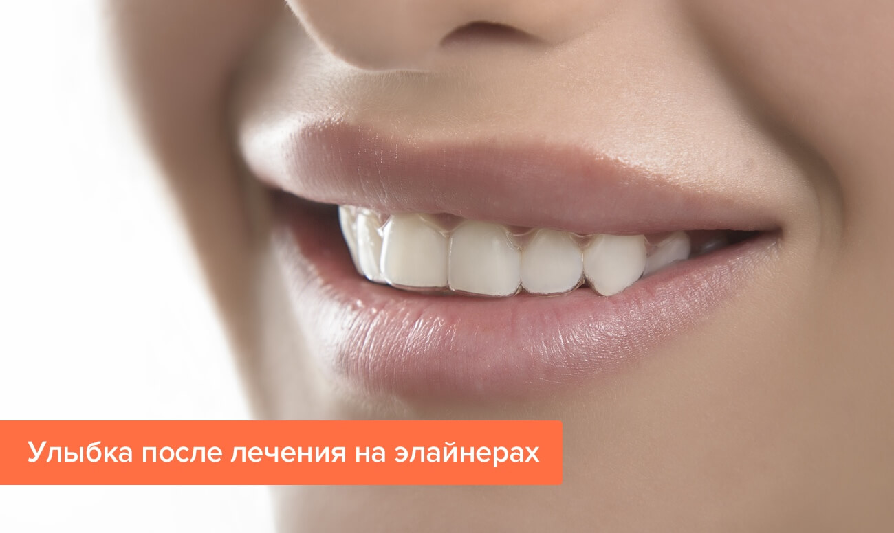 Элайнеры Star Smile на зубах Элайнеры Star Smile на зубах