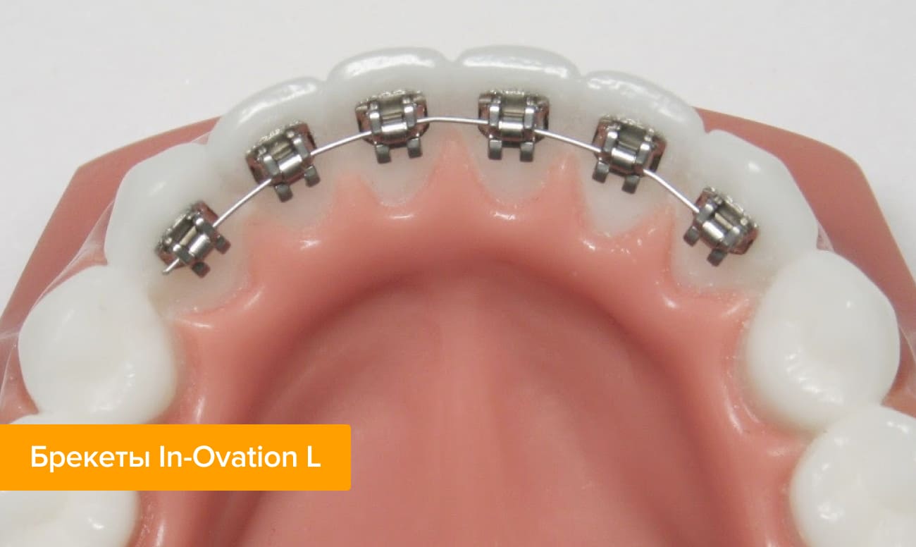 Фото брекетов In Ovation L