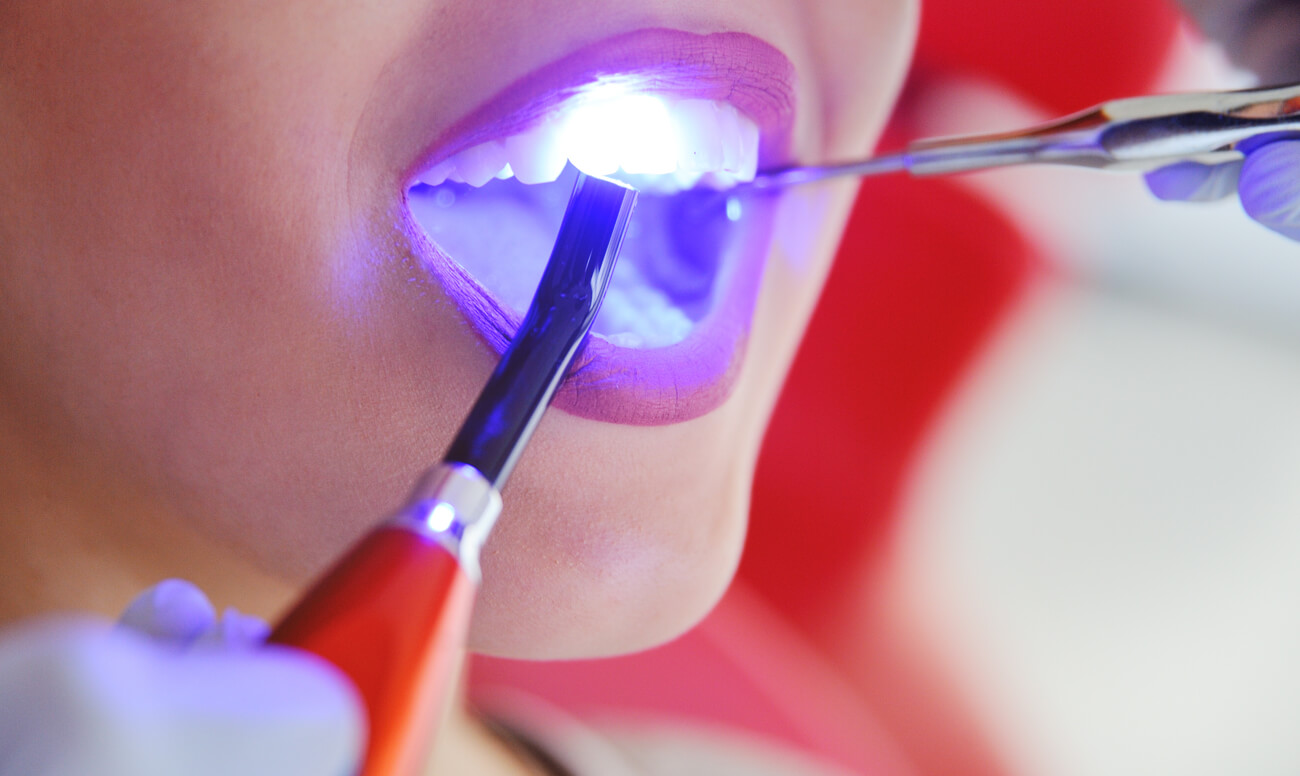 как укрепить эмаль зубов – профессиональные и домашние методы