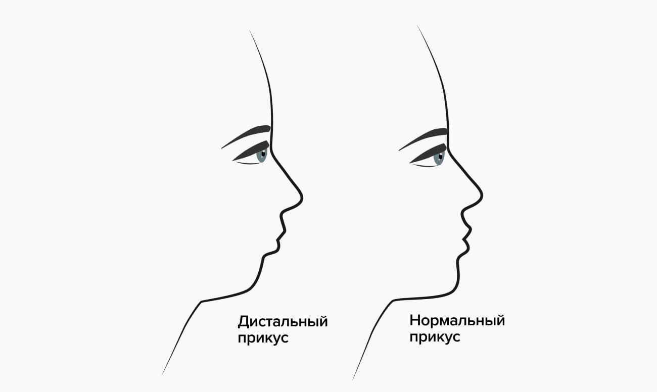Дистальный и нормальный прикусы в картинках