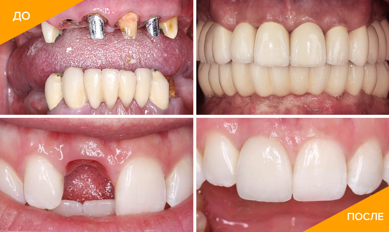 Фото пациента до и после имплантации передних зубов