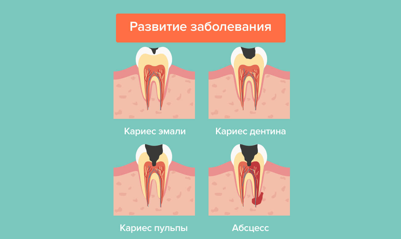 Развитие пульпита в картинках